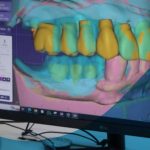 El proceso de diseño digital en prótesis dentales