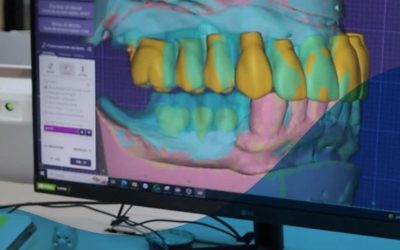 El proceso de diseño digital en prótesis dentales