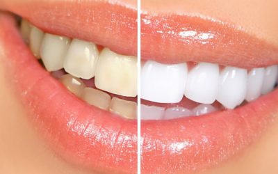 Blanqueamiento dental