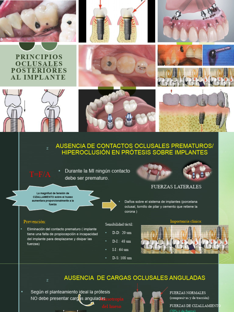 Cuidados Posteriores al Implante Dental