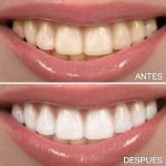 Experiencia personal con blanqueamiento dental profesional
