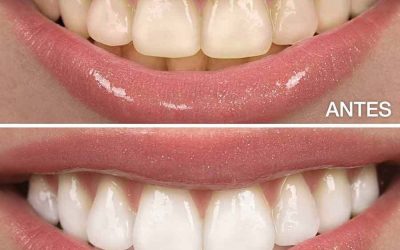 experienciapersonalconblanqueamientodentalpro