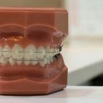 La ortodoncia en adultos: mitos y realidades