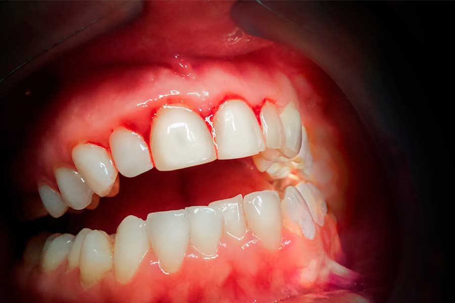 ¿Por qué tengo las encías inflamadas y sangrantes? Causas comunes