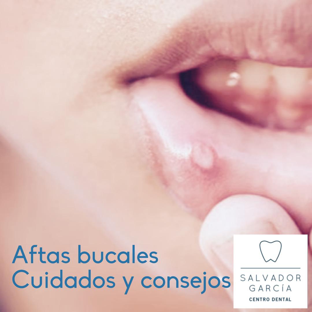 Prevención de las aftas bucales