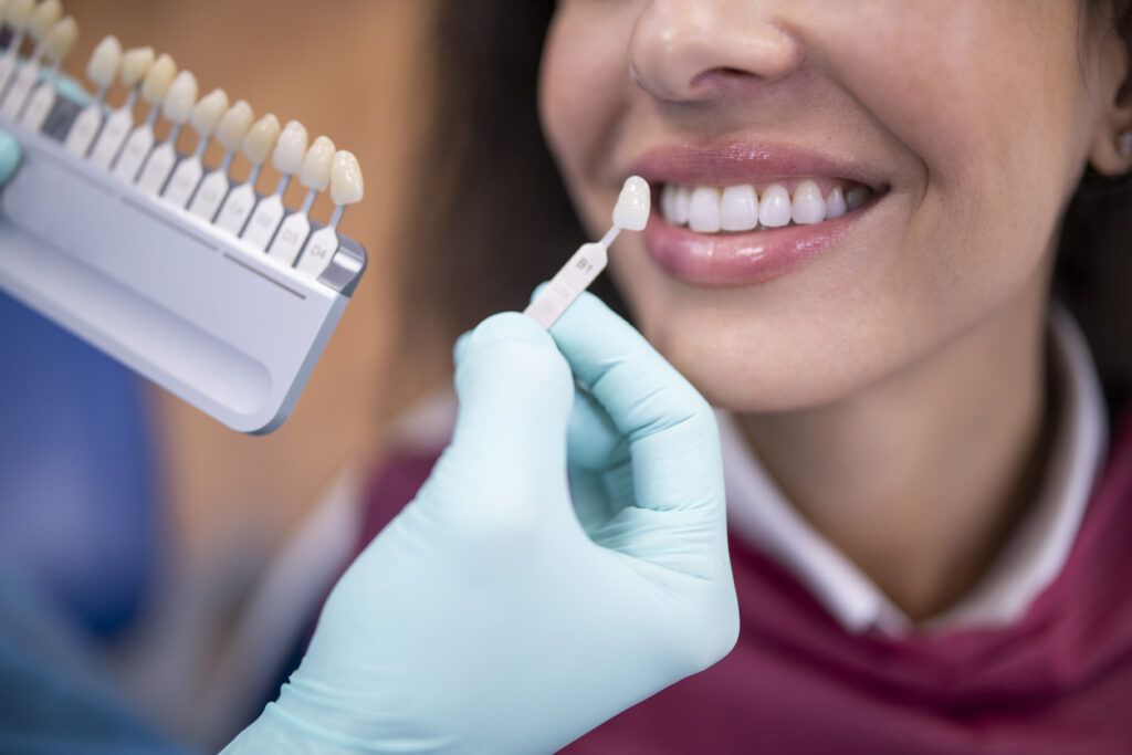 ¿Qué es el blanqueamiento dental y por qué es popular?