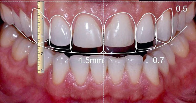 ¿Qué es el Diseño de Sonrisas Digital (DSD)?