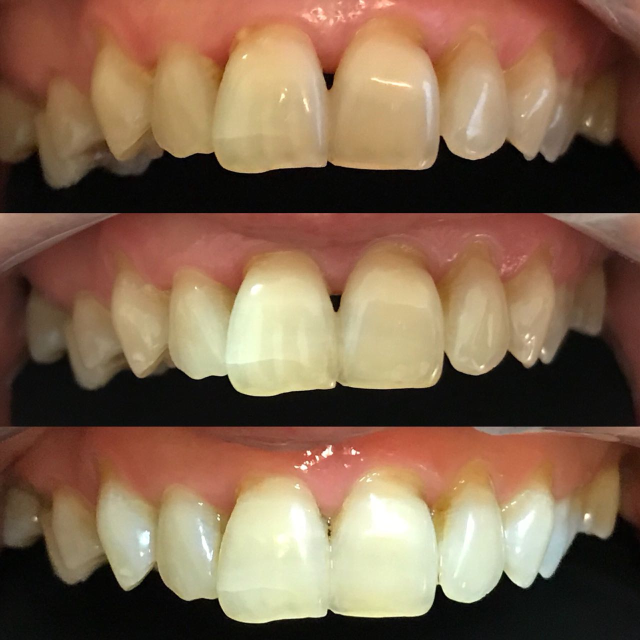 Resultados esperados del blanqueamiento dental