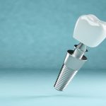 Todo sobre implantes dentales: procedimiento y cuidados