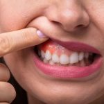 Tratamientos para encías inflamadas y sangrantes