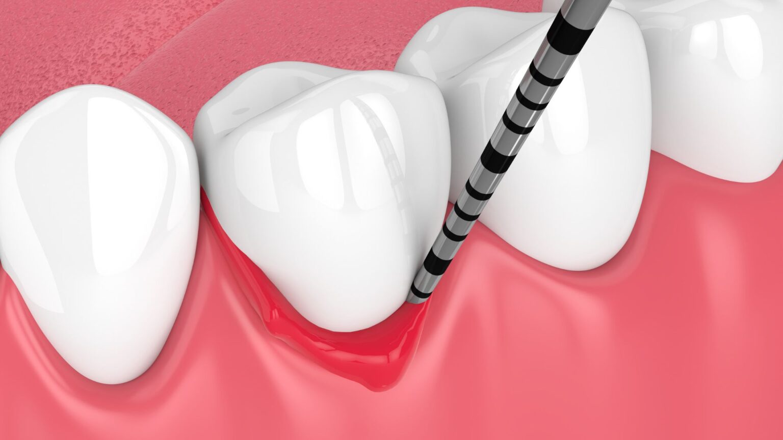 Tratamientos profesionales para la gingivitis y periodontitis