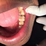 Cómo evitar caries con una rutina diaria efectiva
