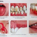 Consejos para evitar la resequedad bucal y sus consecuencias