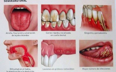 consejosparaevitarlaresequedadbucalysuscon
