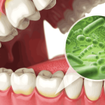 Equipos inteligentes para control de placa bacteriana
