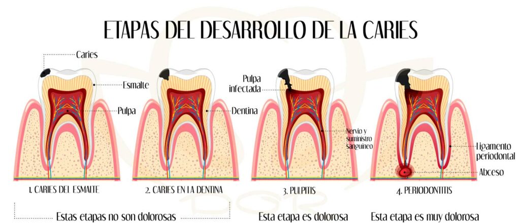 ¿Qué son las caries y por qué son tan comunes?