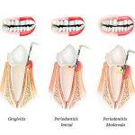 Signos de advertencia de gingivitis que no debes ignorar