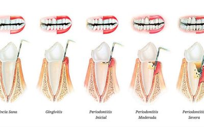 signosdeadvertenciadegingivitisquenodebesi