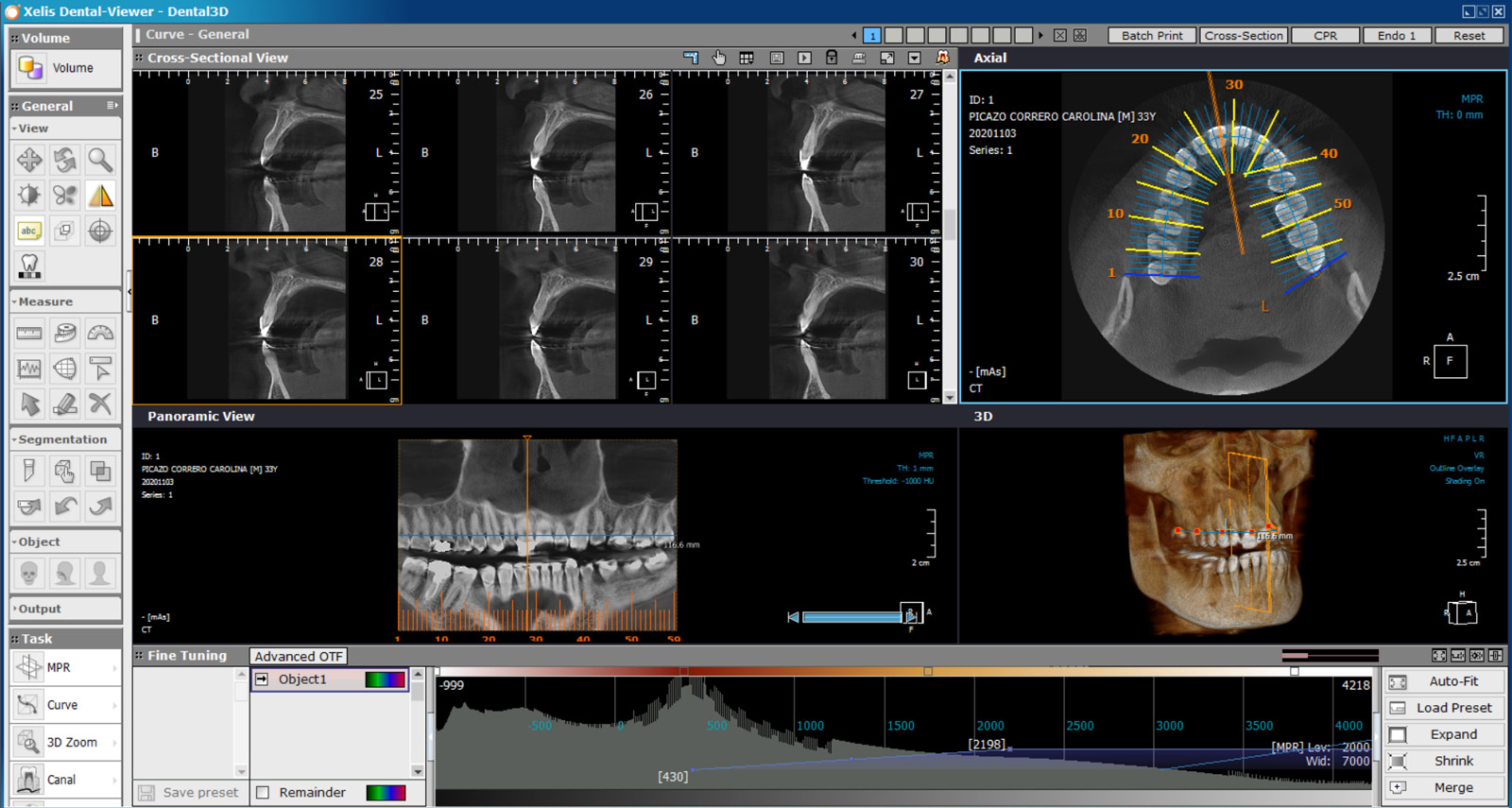 Software de Planificación de Implantes: Mayor Precisión y Eficiencia