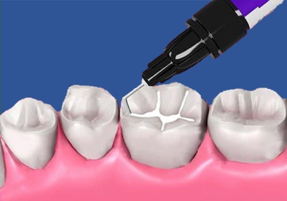 Tratamientos Dentales Preventivos: Un Escudo Protector