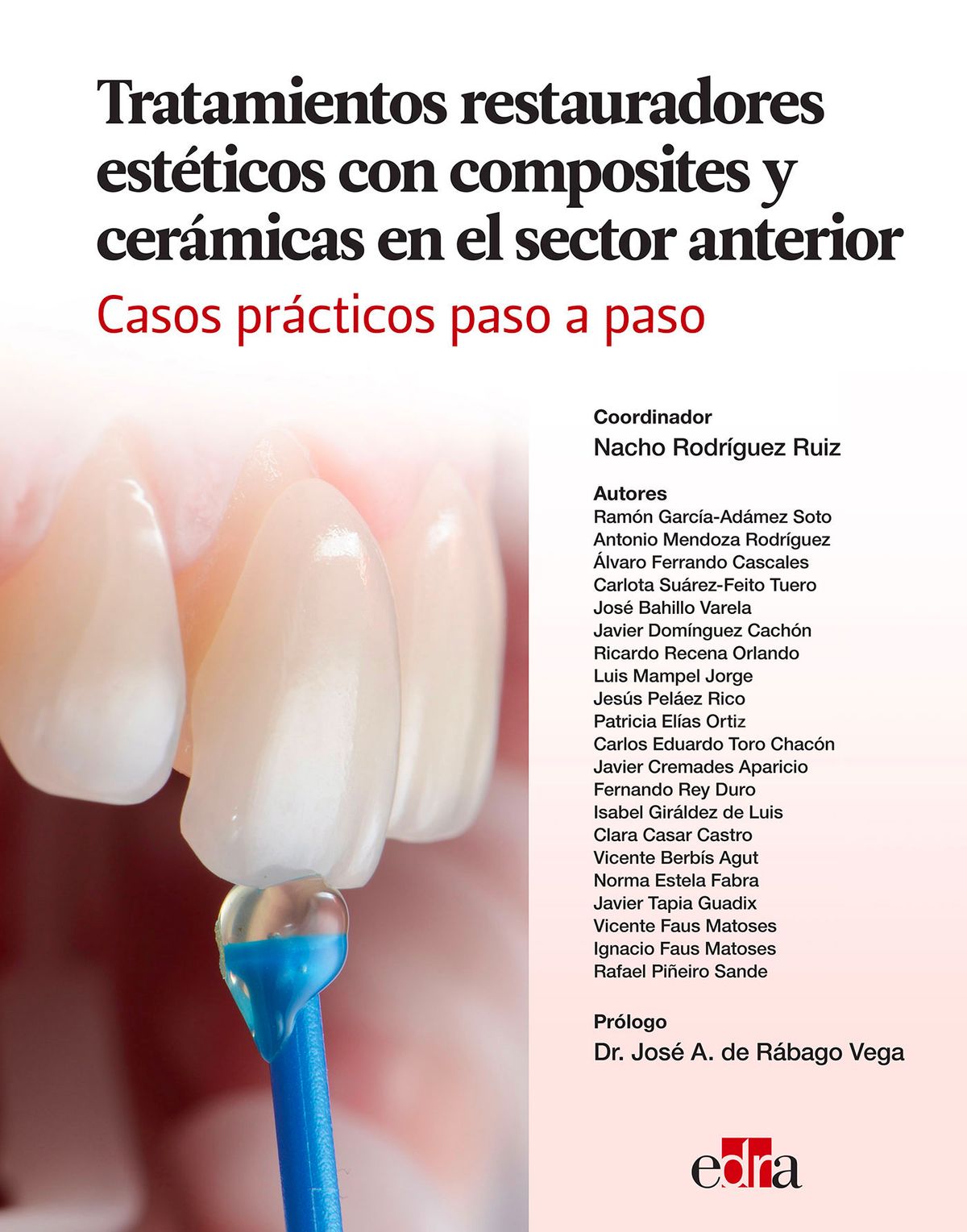 Tratamientos Restauradores para Fisuras Dentales