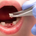 Cómo manejar el dolor después de una extracción dental
