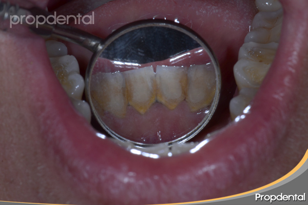 Testimonio: la importancia de la limpieza dental regular 2 Entendiendo el sarro y la placa bacteriana