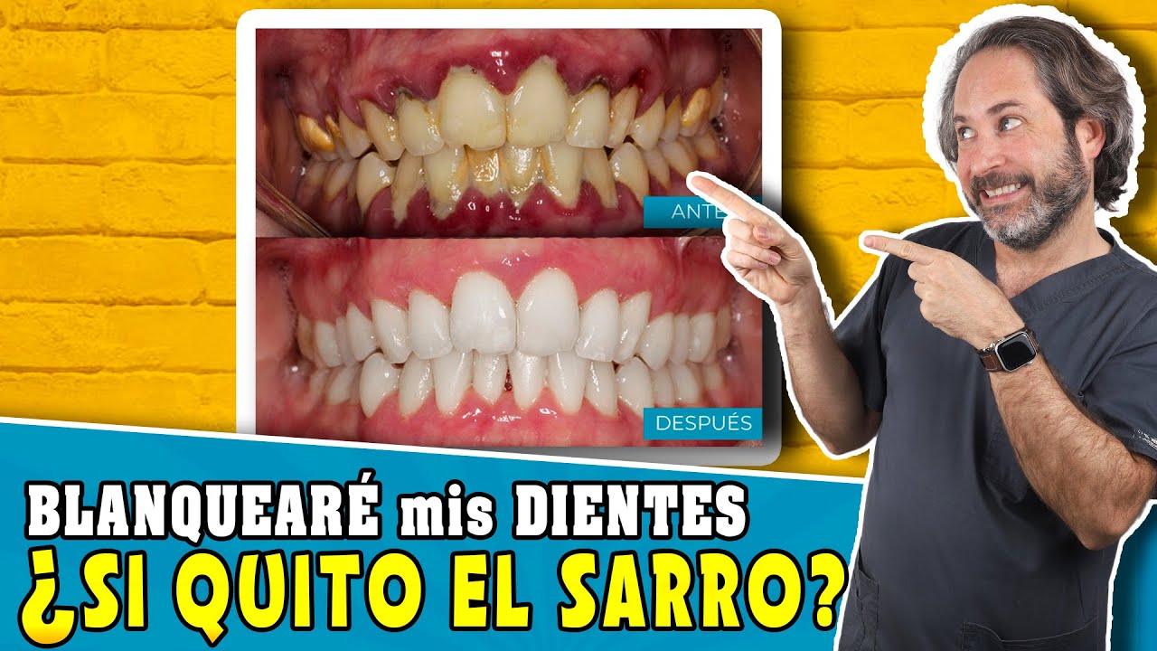 Testimonio: la importancia de la limpieza dental regular 1 Mi Historia: Un antes y un después de las limpiezas dentales regulares