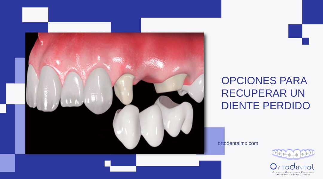 ¿Por qué es importante reemplazar los dientes perdidos?