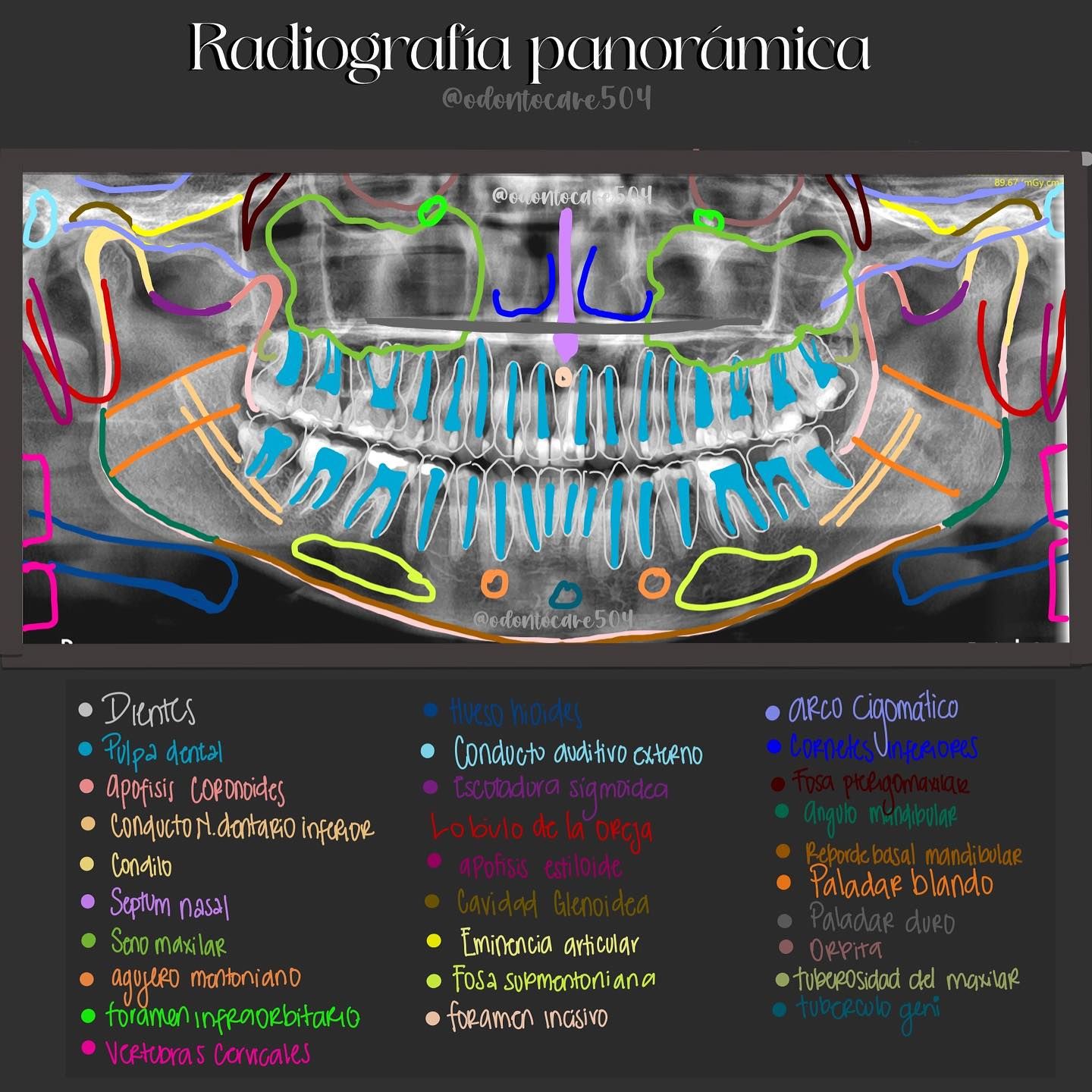 ¿Qué es la Radiografía Digital y cómo Funciona?