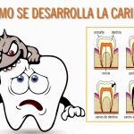 Tecnología para detectar caries en etapas iniciales