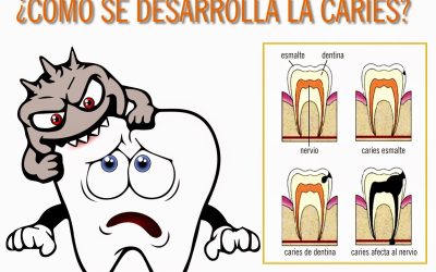 tecnologiaparadetectarcariesenetapasiniciale