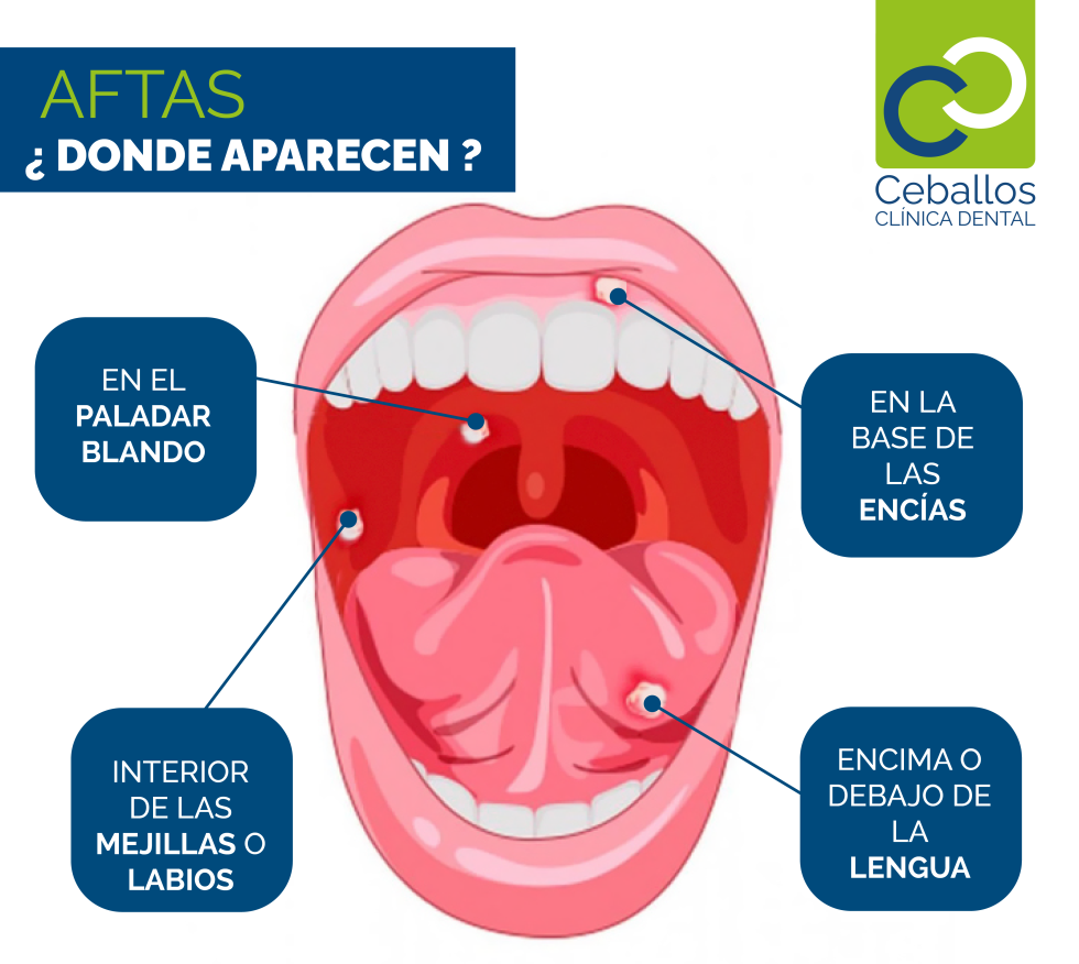 Aftas bucales (úlceras aftosas)