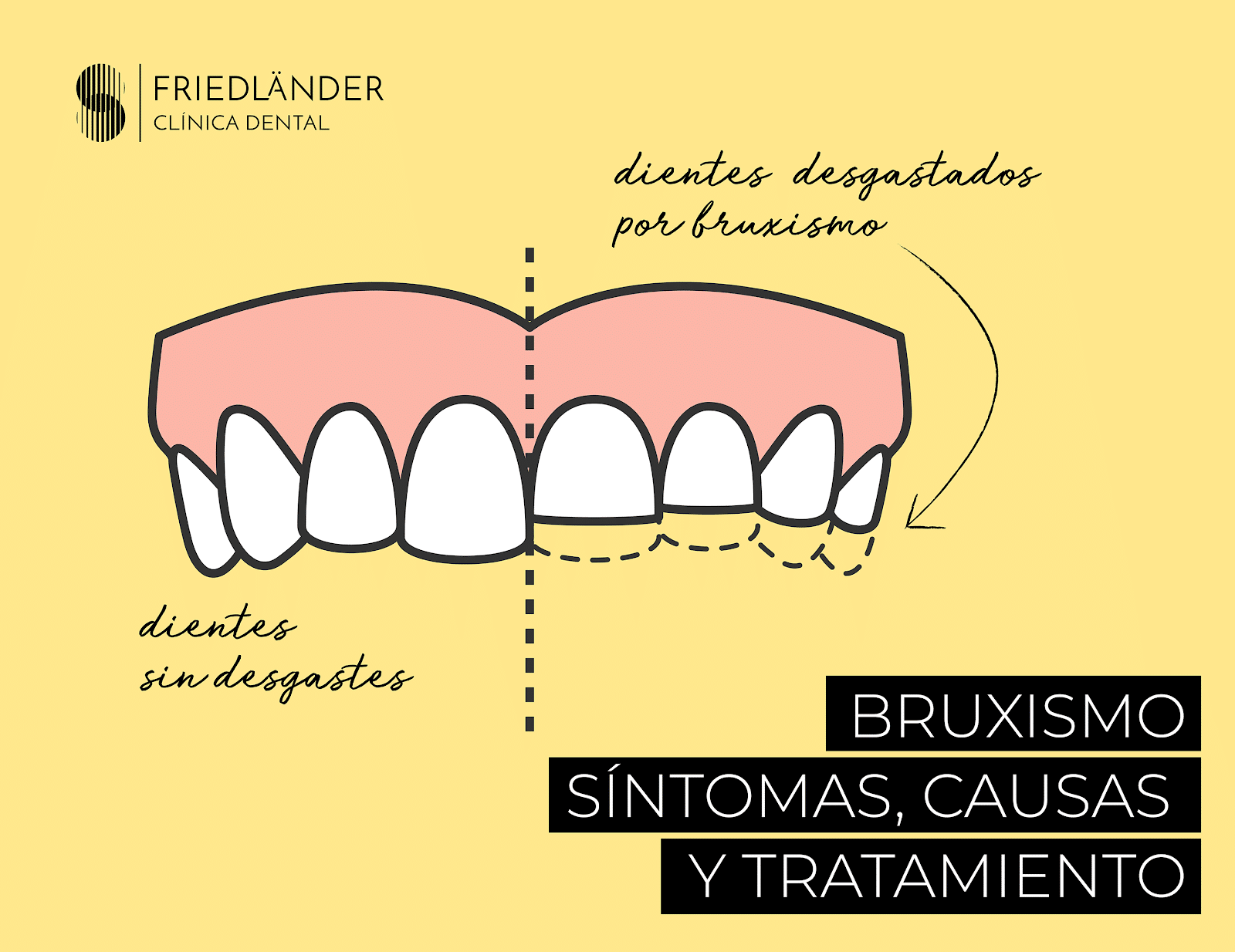 Bruxismo y apretamiento dental