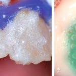 Cómo evitar el daño dental por el uso excesivo de blanqueadores