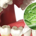 Cómo superé la halitosis con ayuda profesional