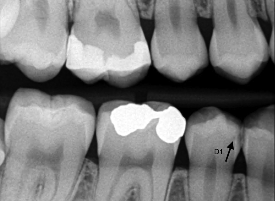 Diagnóstico Avanzado de Caries Profundas