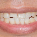 Experiencia con tratamiento para dientes fracturados