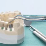 La importancia del mantenimiento post-implantes dentales