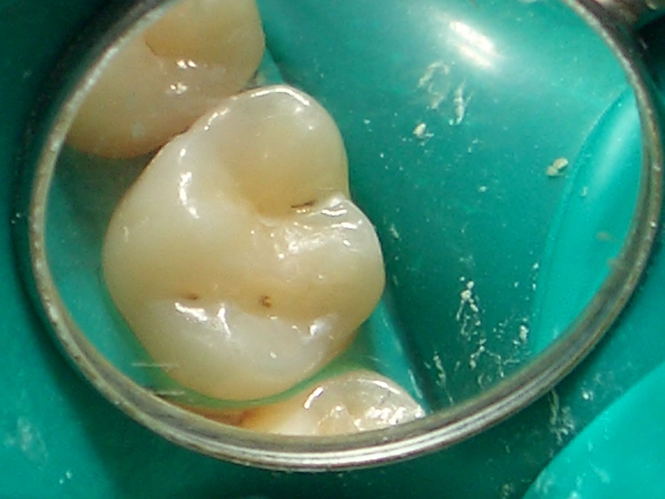 Materiales de Restauración Bioactivos