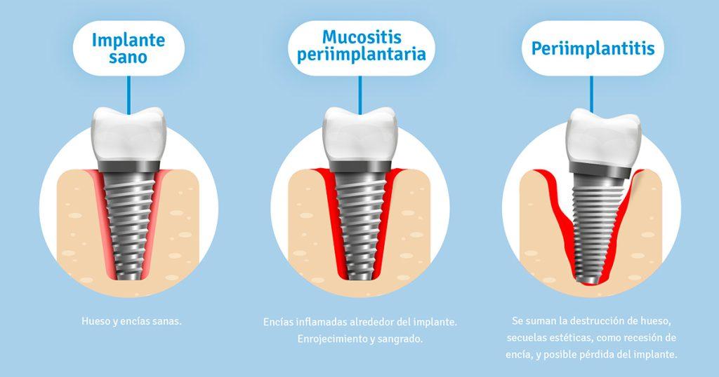 ¿Por qué es crucial el mantenimiento post-implantes dentales?