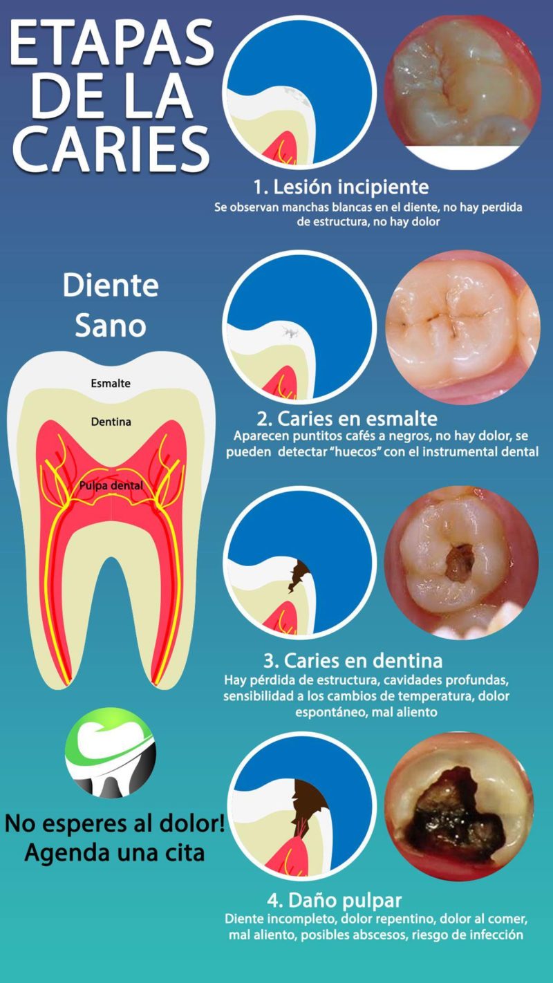 ¿Por qué es importante prevenir la caries desde temprana edad?
