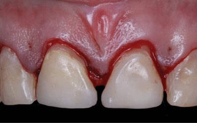 procedimientosparaalargarlacoronadental 693a7