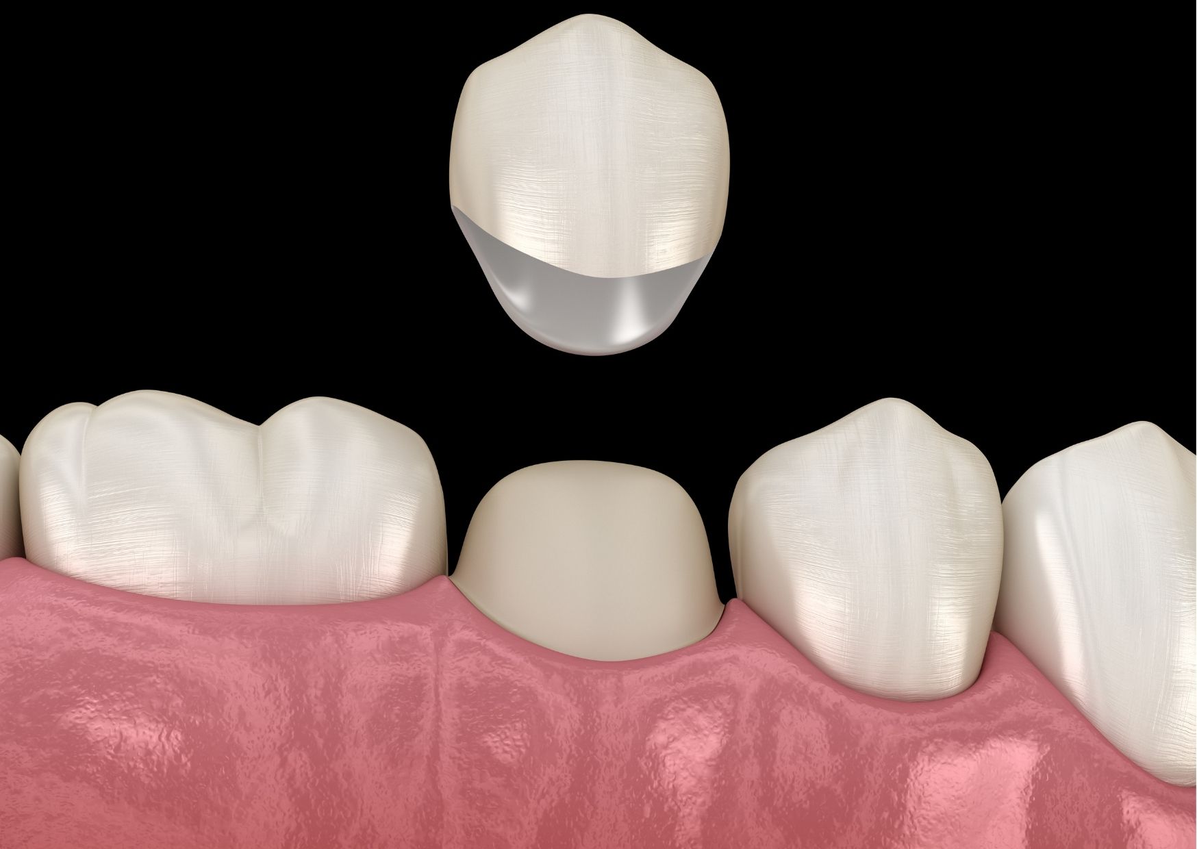 ¿Qué es el Alargamiento de Corona Dental?