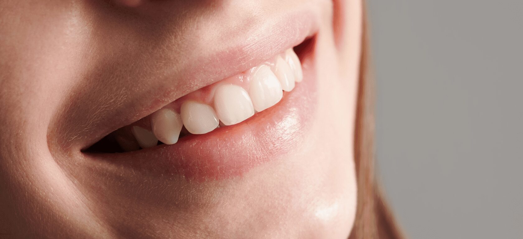 ¿Qué es la Sonrisa Gingival?