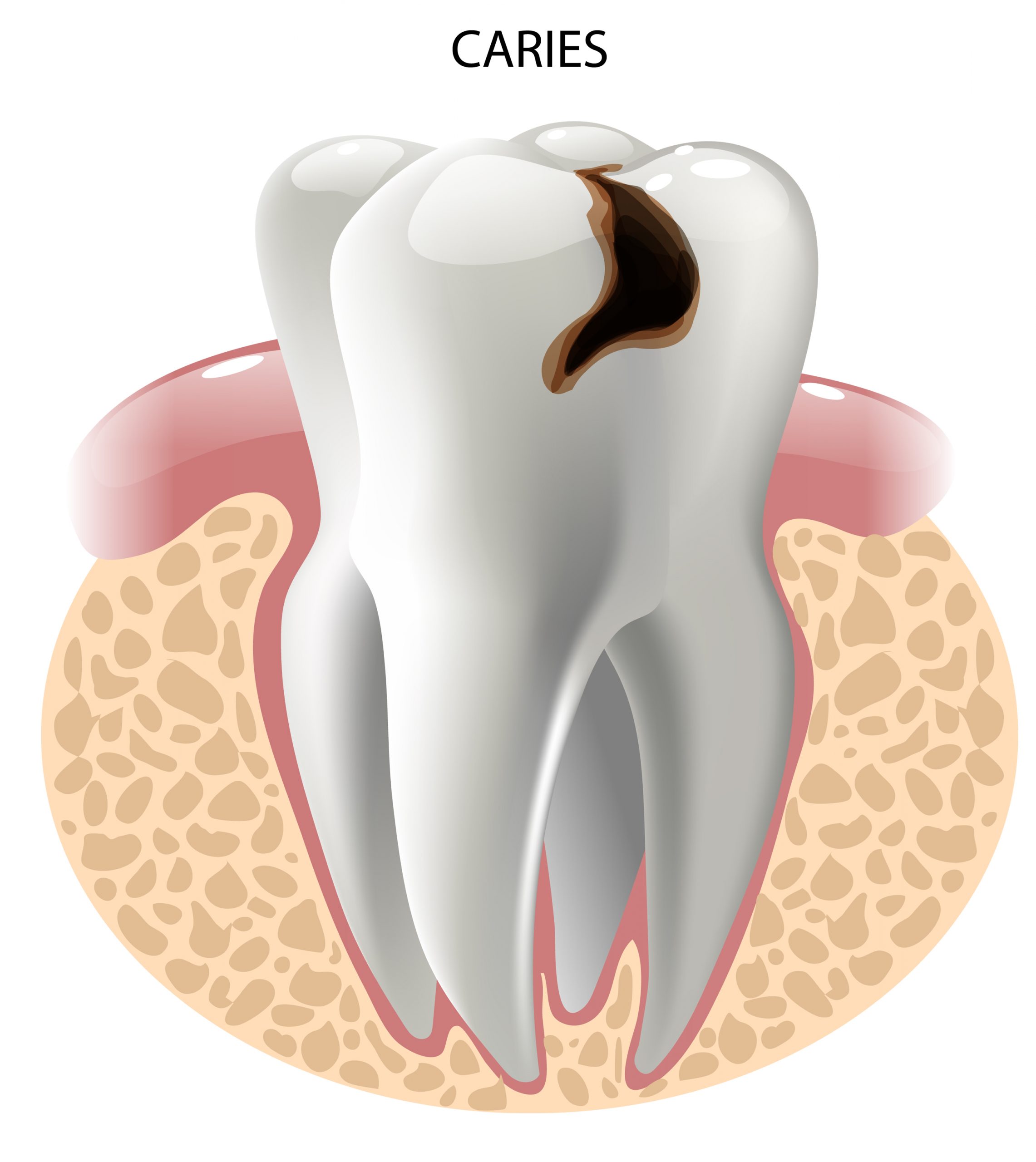 Tratamiento para infecciones dentales avanzadas 1 ¿Qué son las infecciones dentales avanzadas?