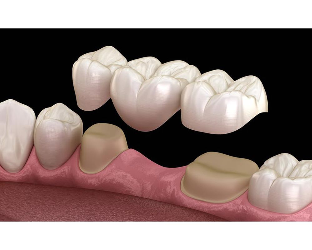 ¿Qué son las prótesis dentales removibles y fijas?