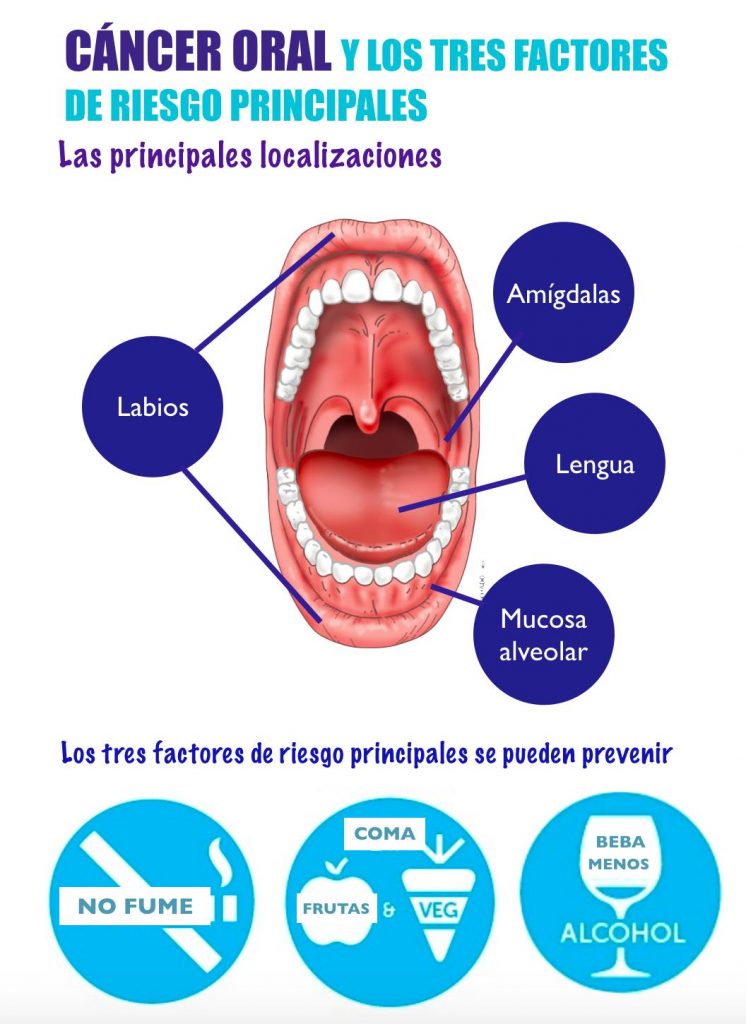 La influencia del alcohol en la salud bucal 2 Riesgo de Cáncer Oral