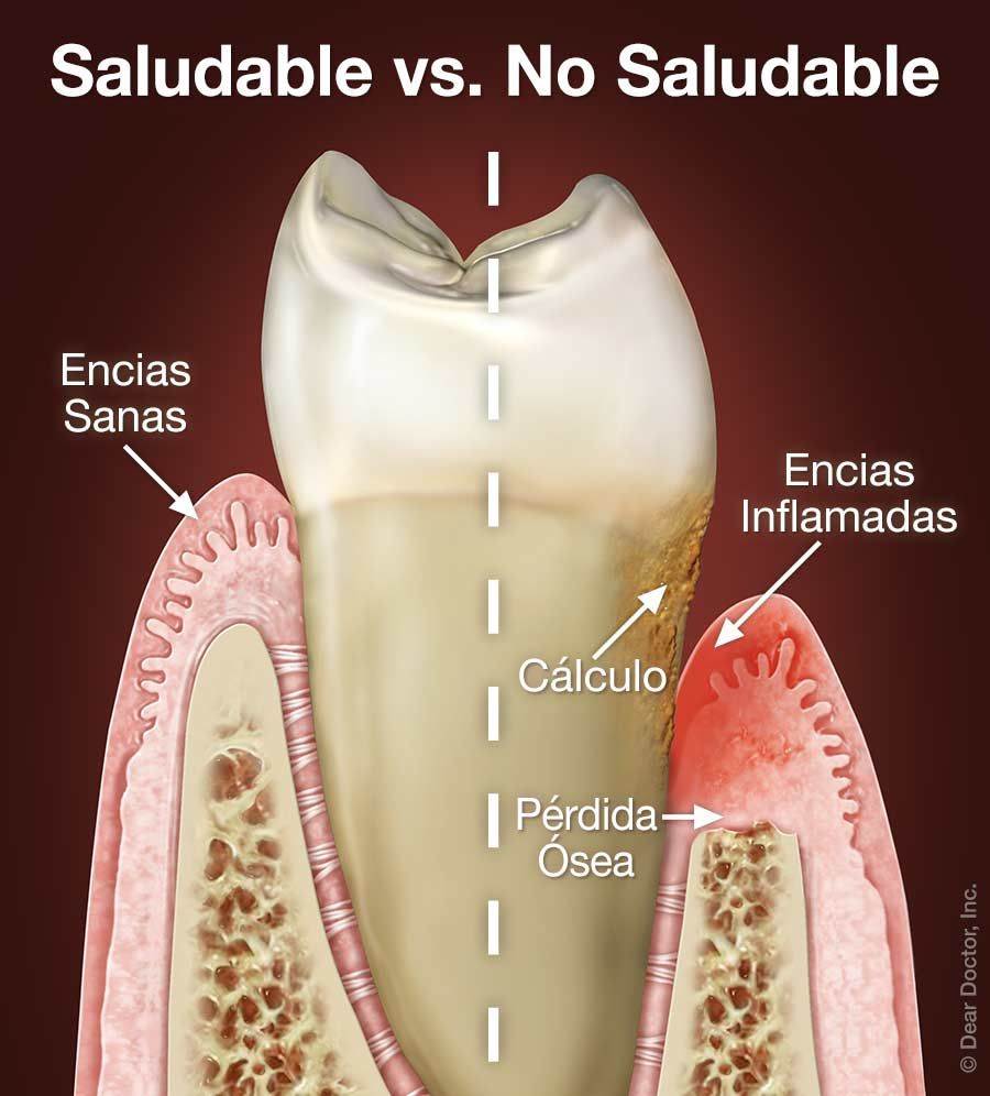 Signos y síntomas de la enfermedad periodontal