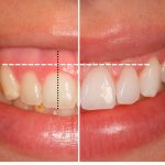 Técnicas para mejorar la sonrisa gingival